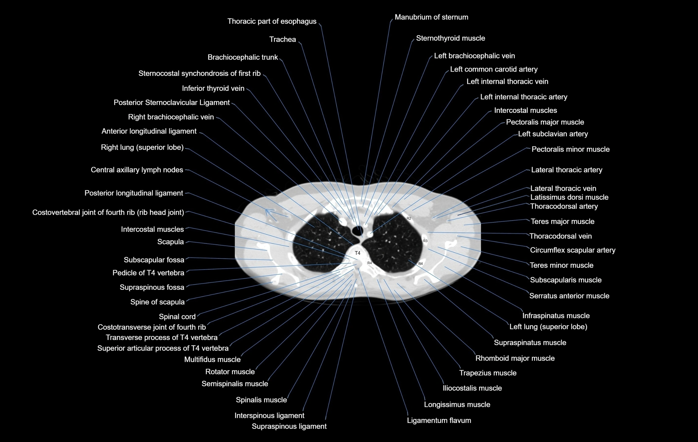 CT chest (thorax) labelled axial cross sectional anatomy radiology image-00023.webp